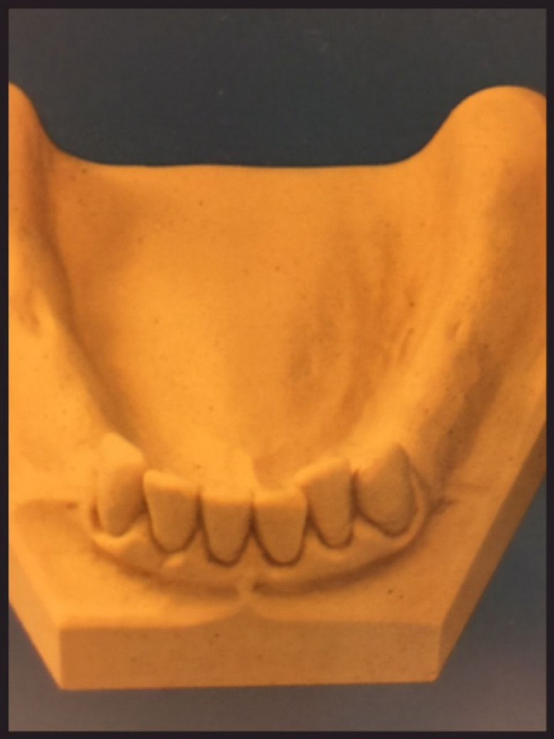 Unterkiefer mit fehlenden Zähnen